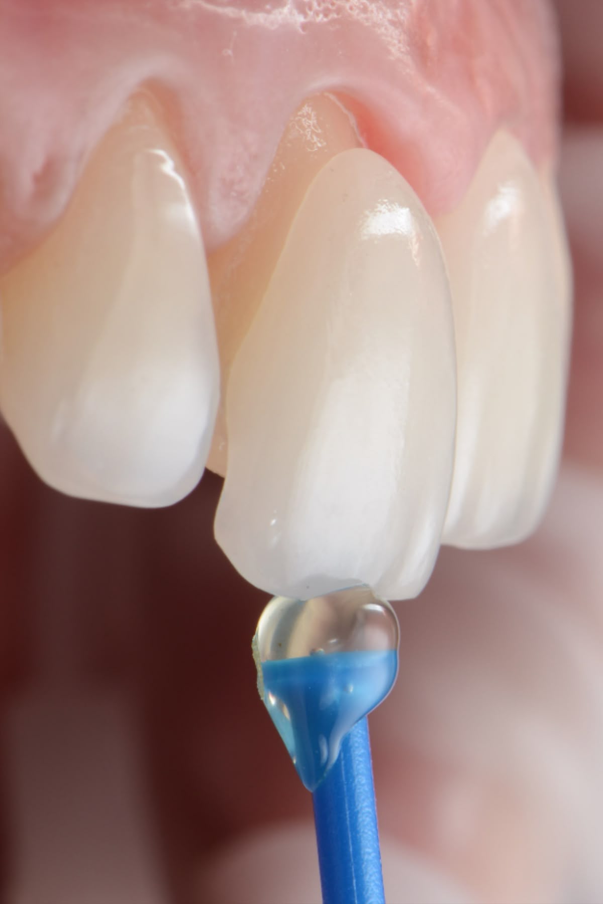 무삭제 라미네이트