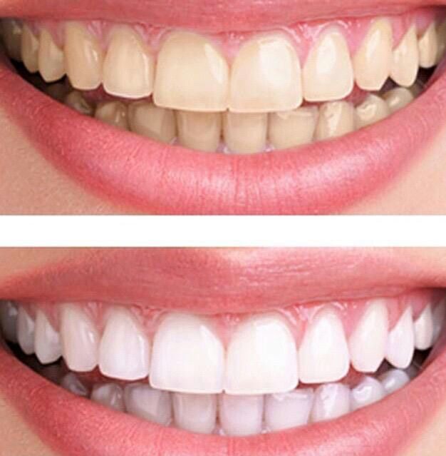 원데이 치아 미백